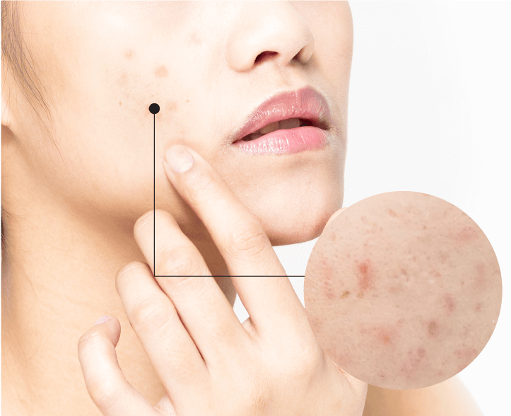 ACNE-&-OILY-SKIN_01